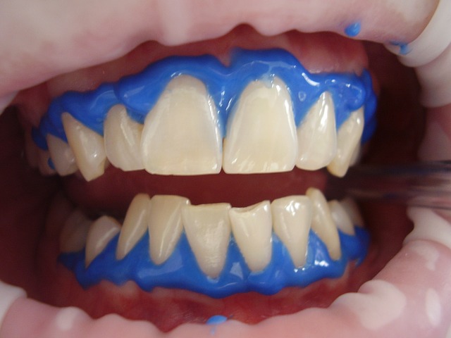 laserové bělení zubů.jpg